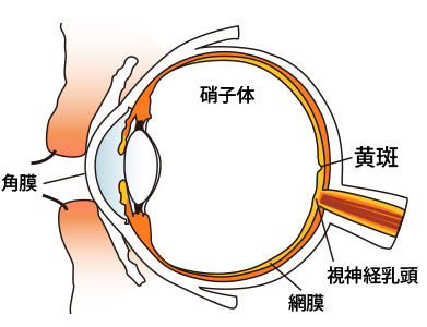 加齢黄斑変性症