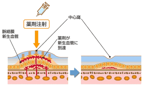 抗VEGF抗体硝子体注射