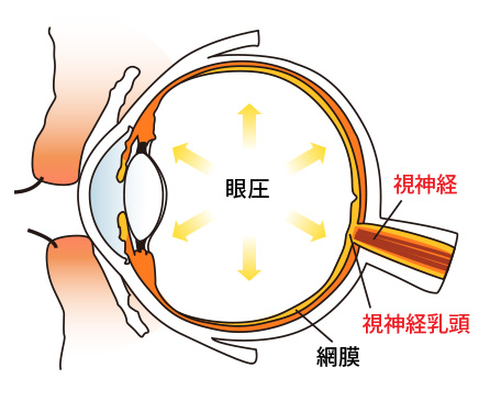 緑内障の仕組み