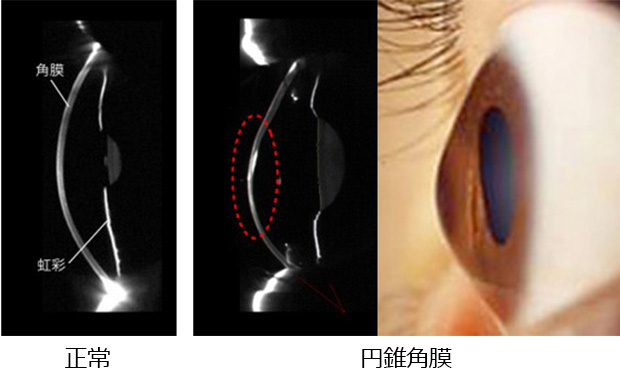正常な角膜と円錐角膜
